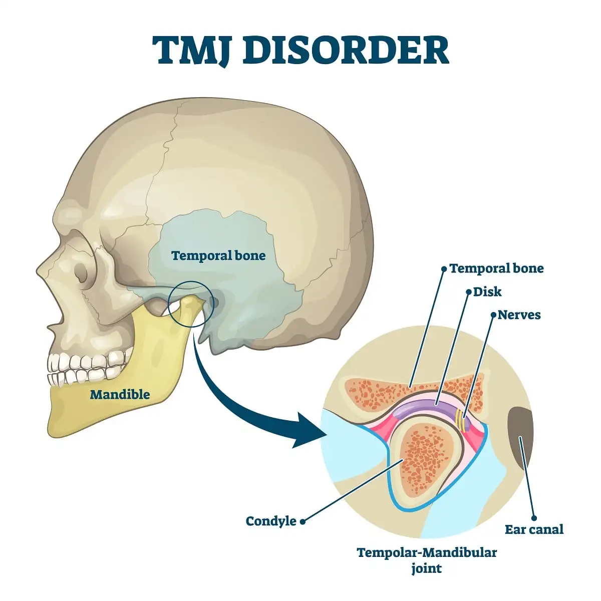 How to Cure TMJ Permanently